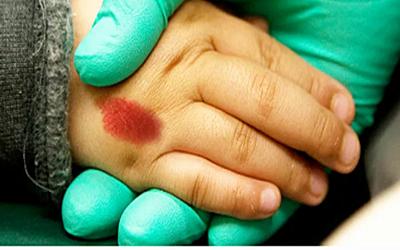 高频电凝微创术治疗血管瘤的危害,婴儿背部血管瘤不治疗有什么危害