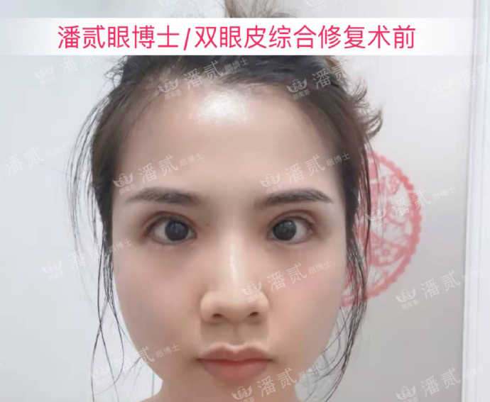 双眼皮手术后眼神凶狠是什么原因,双眼皮手术后显凶