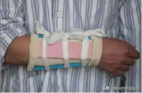 骨折后小夹板固定,骨折小夹板固定方法实操