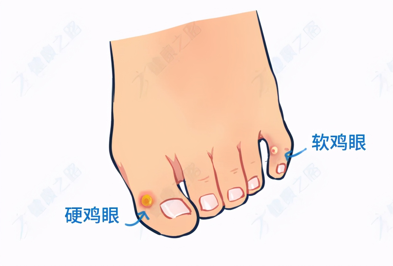 脚底长鸡眼一招搞定,脚底长鸡眼怎么治好了又复发