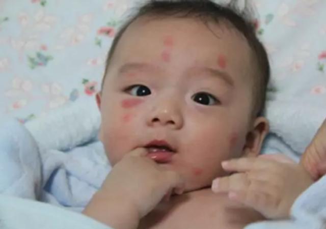 孩子被咬后,若呈现这些状况代表不是蚊子咬的包,别自行处理