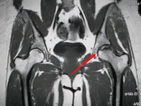 股骨头坏死和腰间盘突出症状区别,椎间盘突出和股骨头坏死症状区别