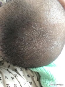 宝宝长舅舅屎的前兆,宝宝头上的舅舅屎每个宝宝都有吗