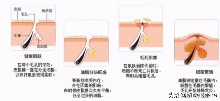 油皮水乳套装推荐收缩毛孔祛闭口,混油皮毛孔粗大有闭口怎么改善