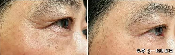 大眼袋眼纹抹平了,眼纹医美怎么去除