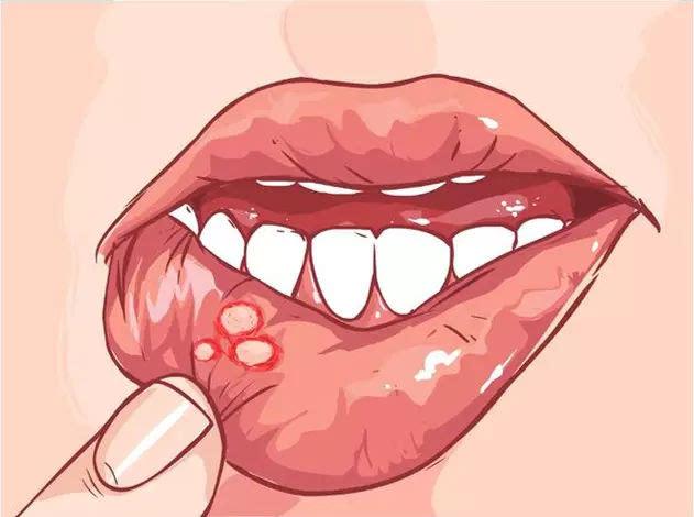 最全面的口腔溃疡治疗方法详解,怎么快速治愈严重口腔溃疡