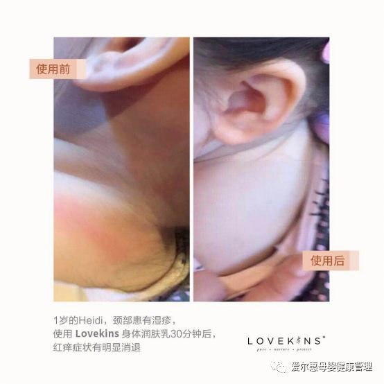 婴儿湿疹反复发作怎么办,脚上湿疹反复发作如何除根