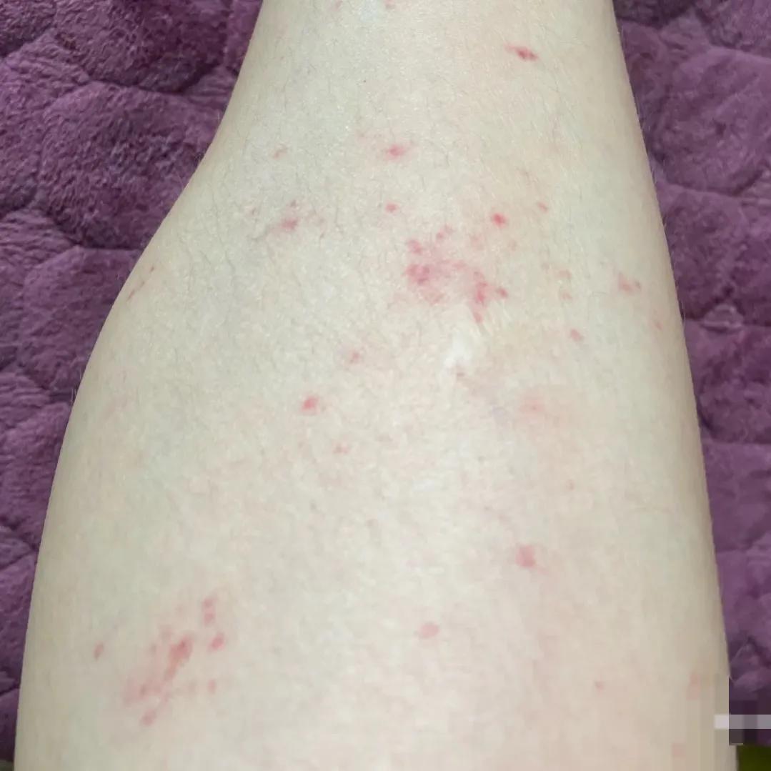 糖尿病人下肢出现出血点,下肢细小出血点什么样子