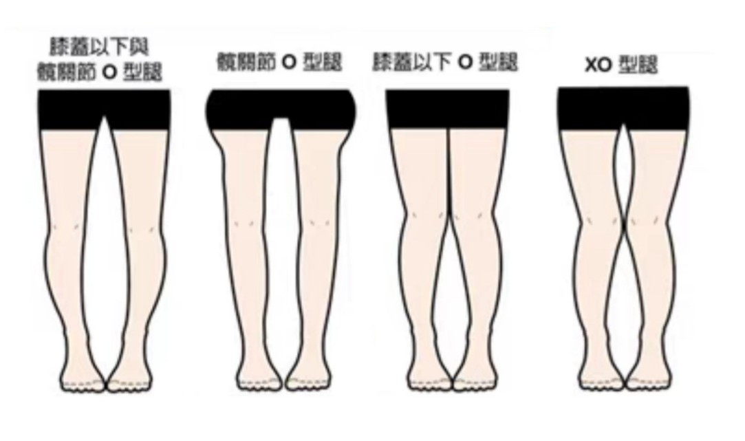 12岁o型腿还能自己矫正过来吗,脚踝关节导致的o型腿该怎么矫正