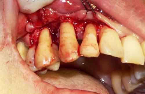 一碰就出血不易止住,轻轻一碰就出血是什么原因