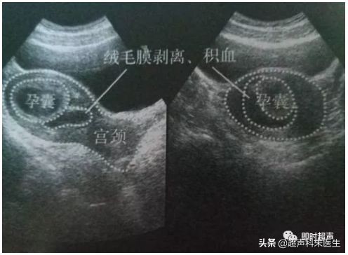 妇科超声的标准超声图,妇科超声图解
