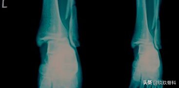 陈旧性踝关节损伤的治疗,踝关节损伤现场处理视频