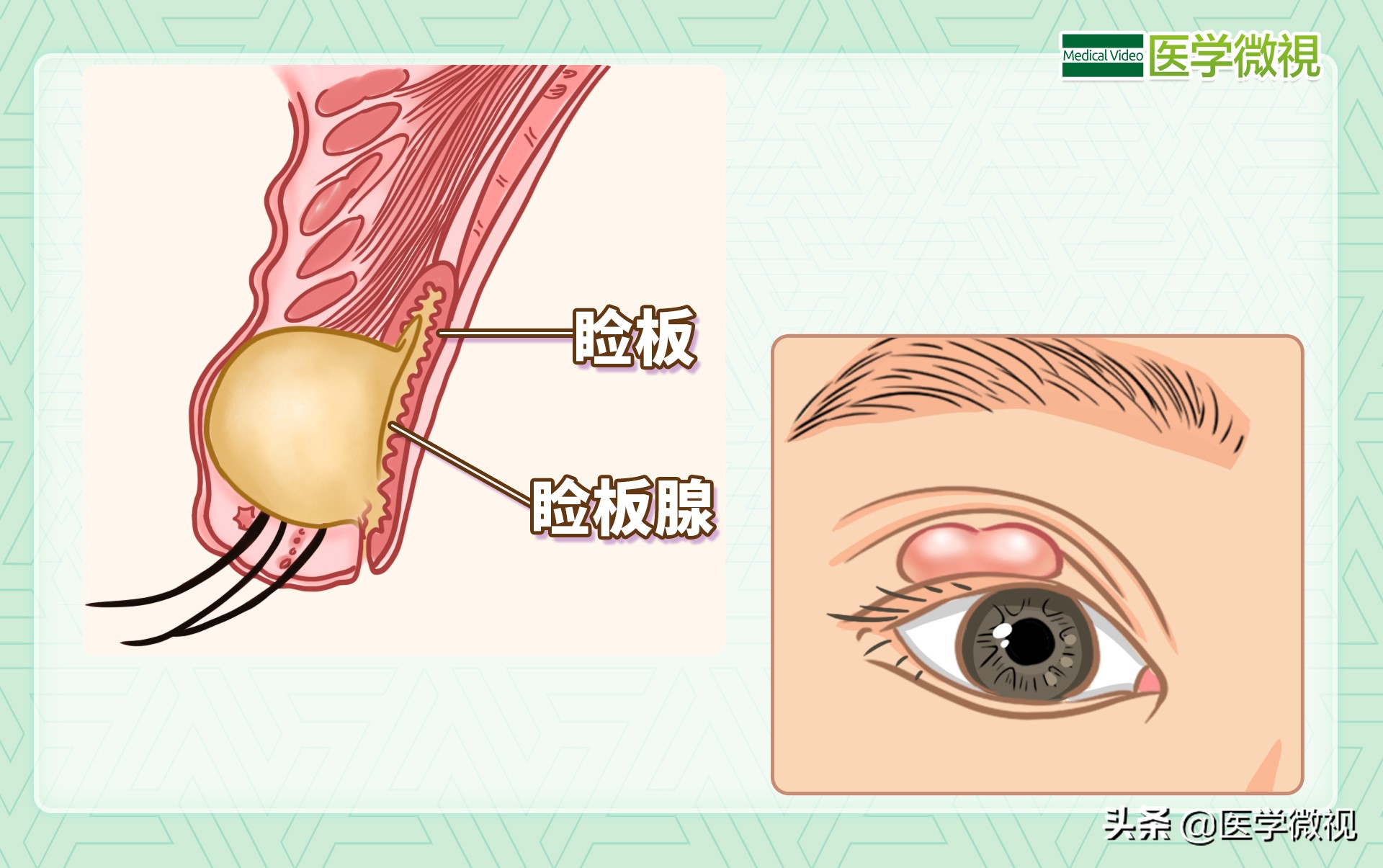 成年人如何预防霰粒肿复发,霰粒肿扎破能好吗