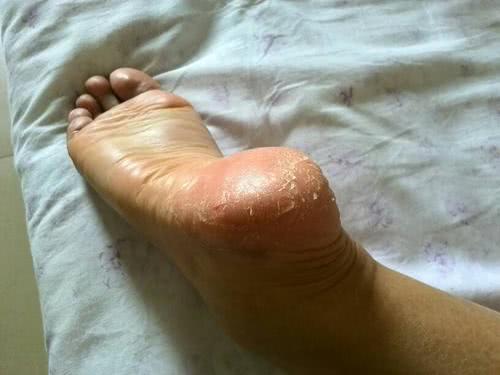 脚后跟干裂开口子吃什么维生素,脚后跟干裂是缺乏什么吗