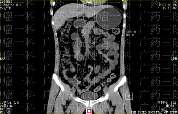 广州广药三院治疗肿瘤,广药三院肿瘤