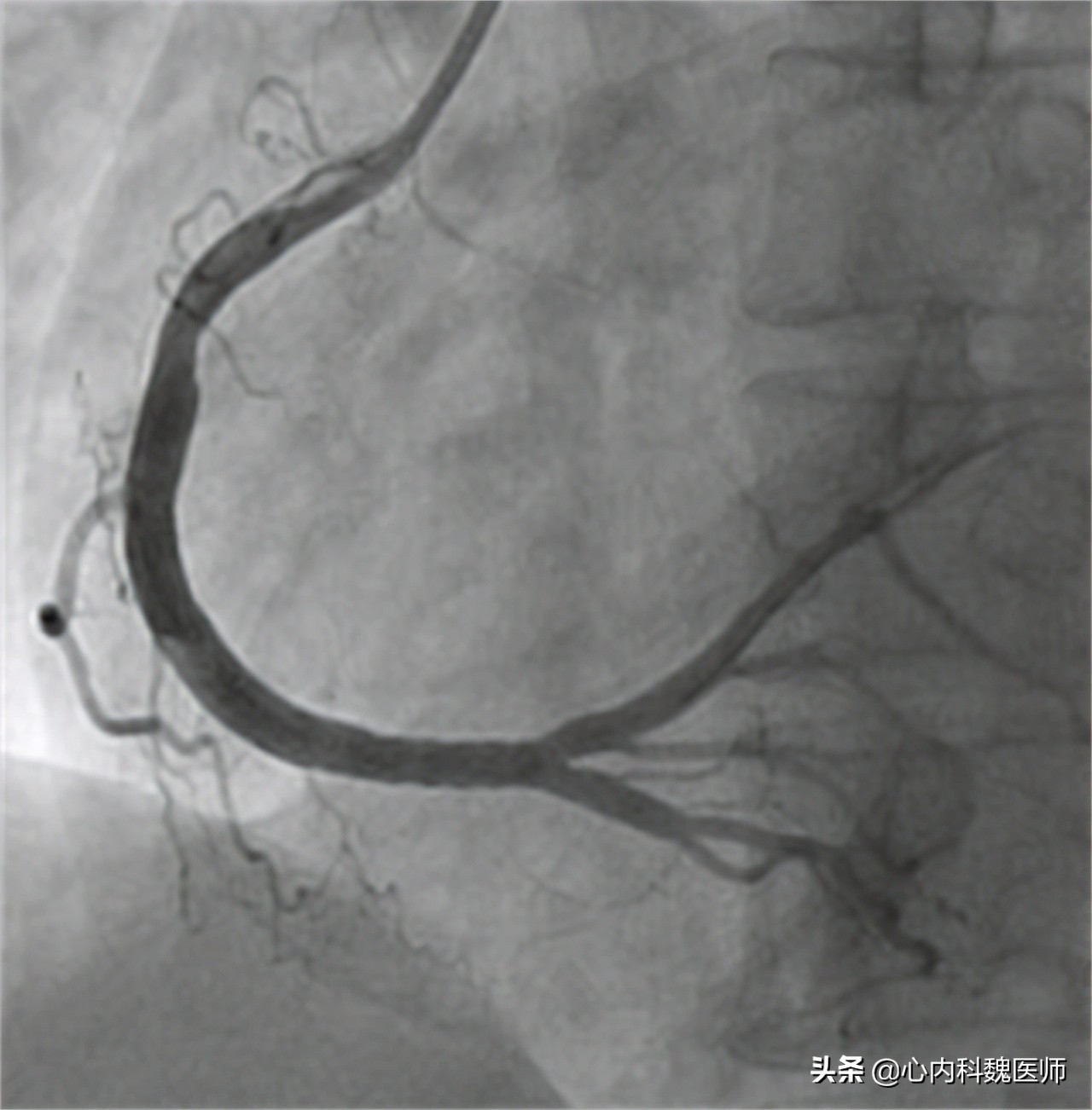 冠心病需要每年复查冠脉造影吗,冠脉造影能根治冠心病吗
