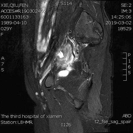 「不死的癌症」之克星——子宫腺肌症介入栓塞治疗