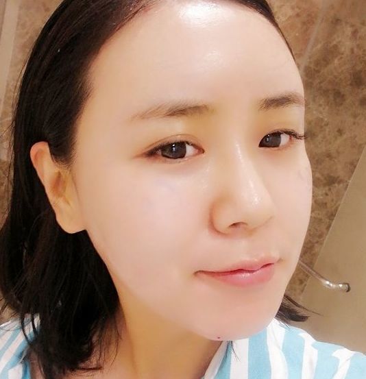 额头扁平怎么填充自然好看,额头颞部怎么填充好看