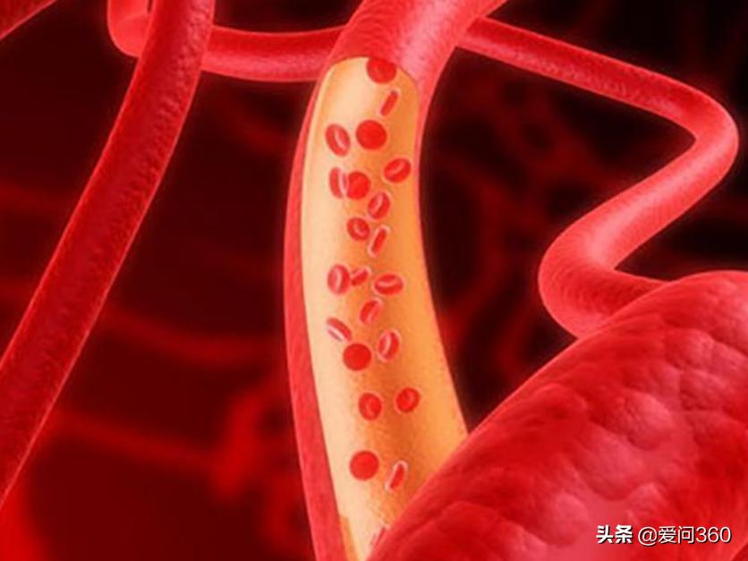 70岁老人血粘度低,老人血粘度偏高怎么调理