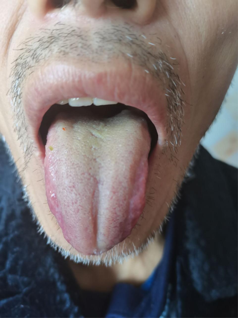 高血压病最新治疗方法,高血压病中医最新诊治思路