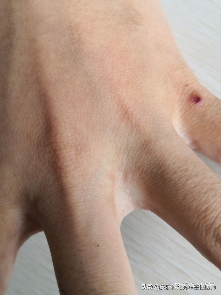 疥疮具有诊断意义,疥疮在临床上如何确诊