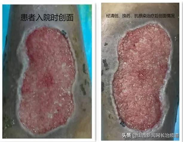 长治二院胬肉手术,长治二院拇外翻手术