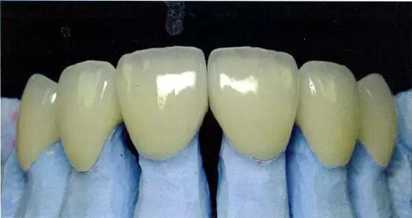 烤瓷牙崩瓷露出里面金属有毒吗,钛合金烤瓷牙有毒吗