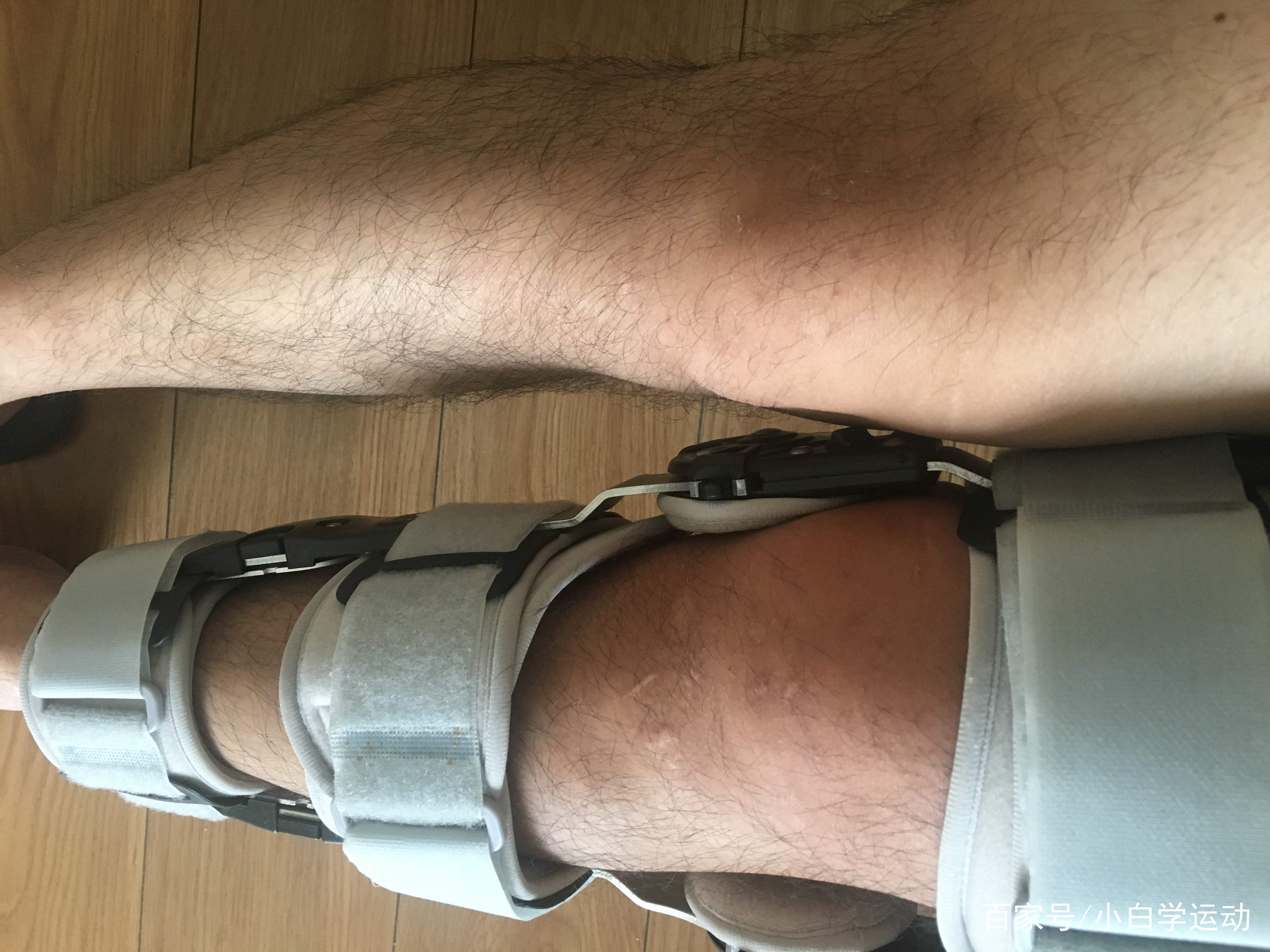 瑞典墨尼克疤痕贴,瑞典墨尼克敷料