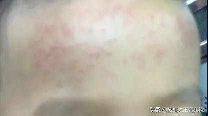 退热贴如何退热,退热贴和退热栓