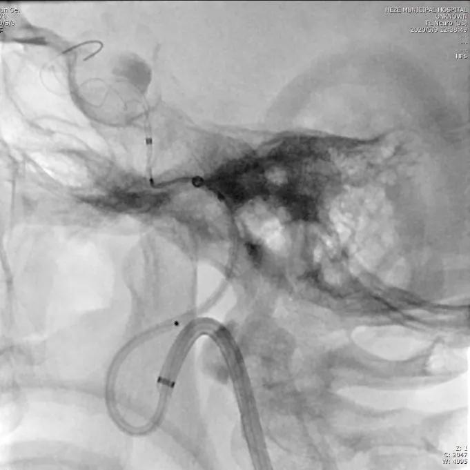 山东治脑动脉瘤最好的专家,菏泽市市立医院血管外科