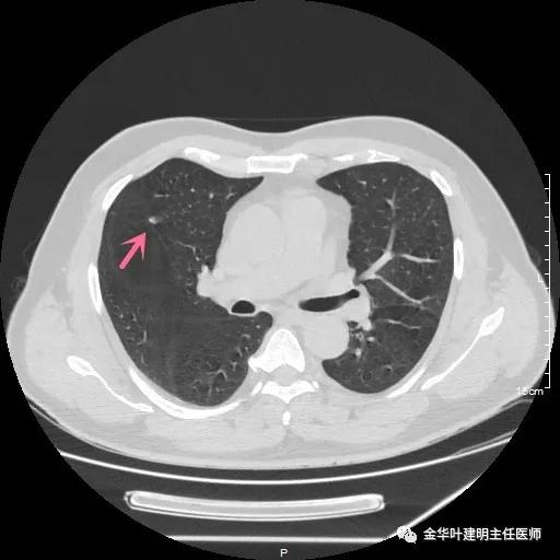 医者仁心过度治疗,肺实性结节多大需手术
