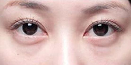 激光祛眼袋适合哪类人,生姜祛眼袋的正确方法