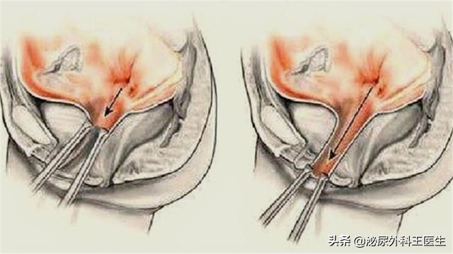 结婚1年才发现妻子是“石女”，丈夫崩溃，究竟什么是石女？