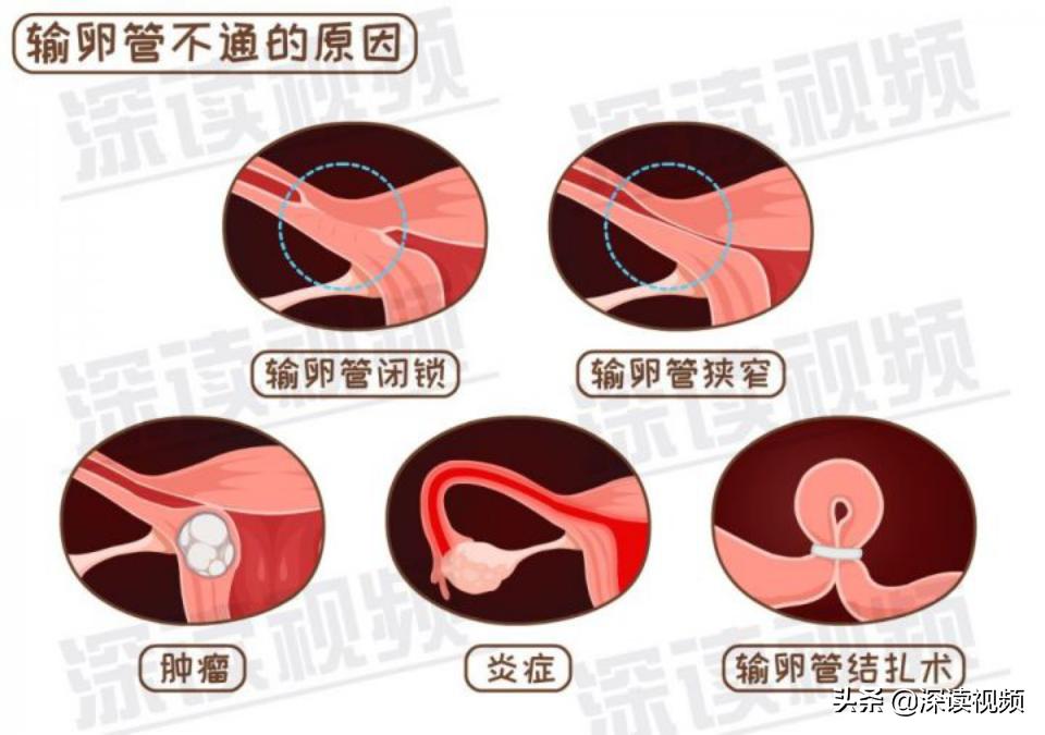 宫外孕出血量和月经一样怎么回事,宫外孕是怎么回事能不能再生孩子