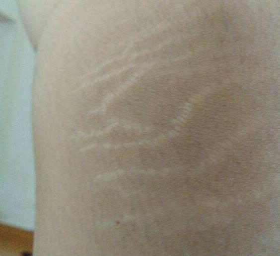 腿上有生长纹是还会长吗,怀孕四个多月大腿上长妊娠纹