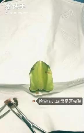 我在快手上看人切洋葱，竟然弄懂了剖腹产？