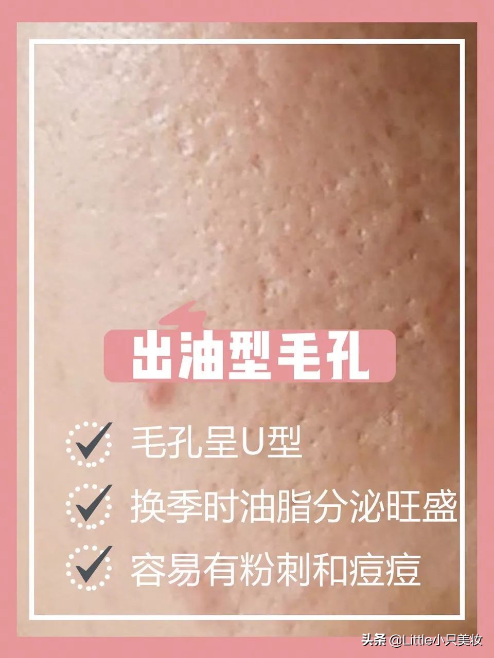 拯救小秘密,拯救毛孔粗大黑头粉刺