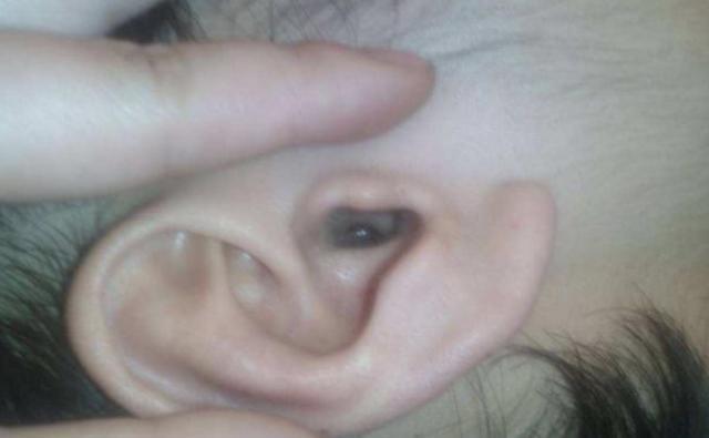 孙女耳朵里意外进飞蛾，奶奶教科书式救助，医生知道后都连连称赞