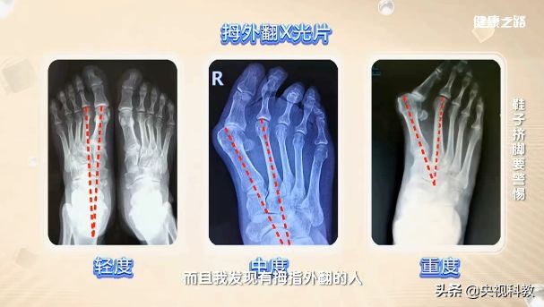 让你又丑又疼的拇外翻矫正方法在这里！还有测试哦