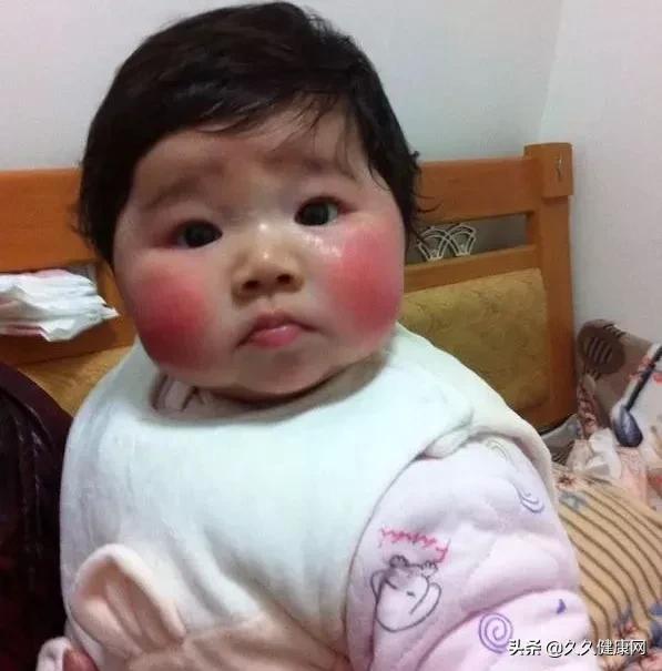 宝宝红脸蛋是食火吗,宝宝红脸蛋是因为角质层受损了吗