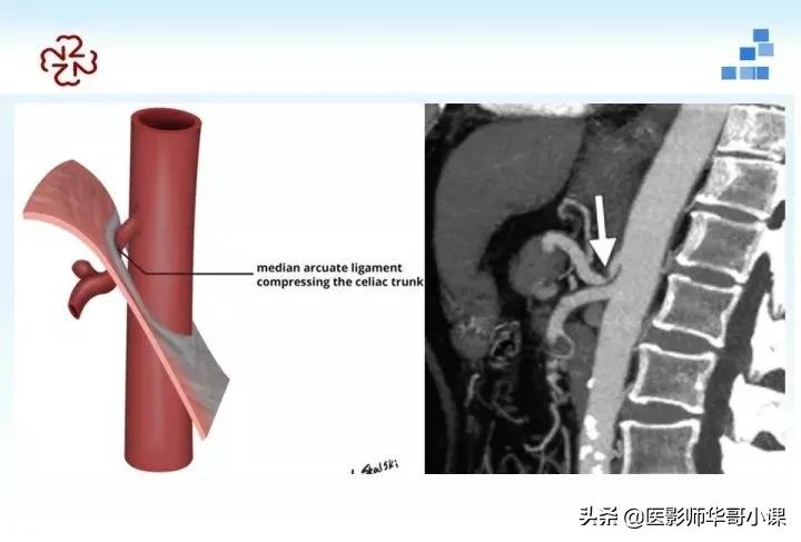 「精品课件」胸部膈肌的解剖及常见病变影像的表现