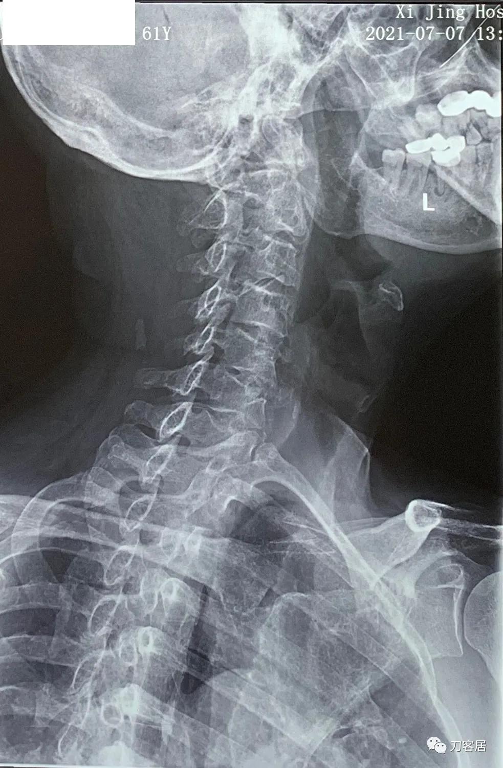 病例左侧躯体麻木,右侧肢体麻木典型病例