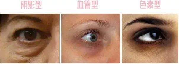 黑眼圈类型怎么辨别,黑眼圈类型怎么分辨