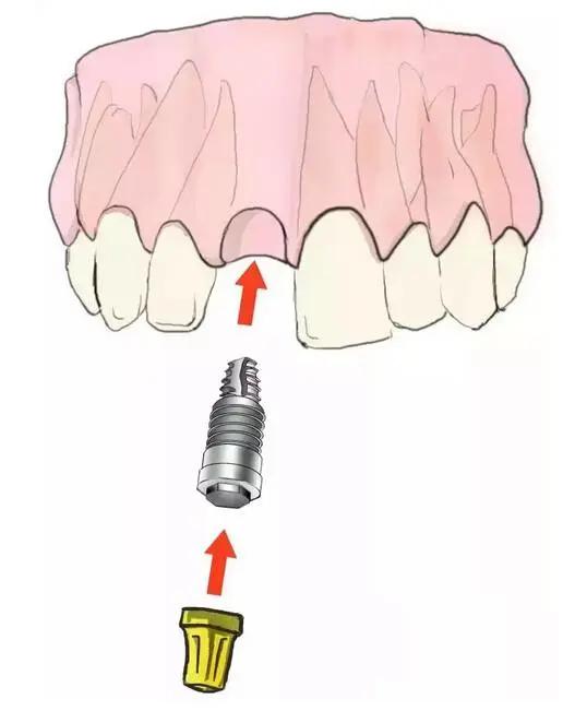 传统的种植牙和即刻种牙的区别,什么是种牙方法