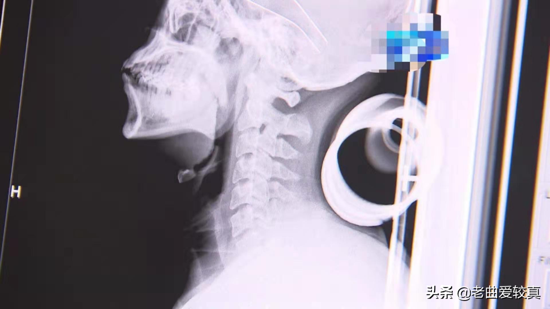 枕酒瓶子治颈椎,枕艾草可以治疗颈椎病吗