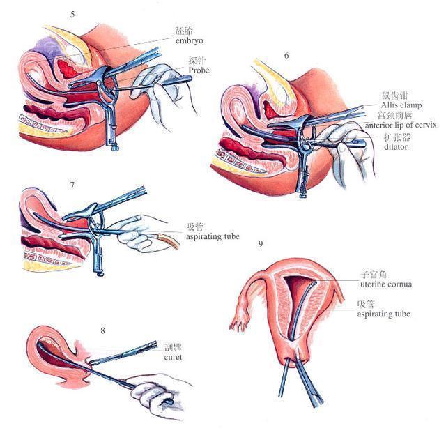 短效避孕药优思悦为何可以用于人流术后？听听药师的解答