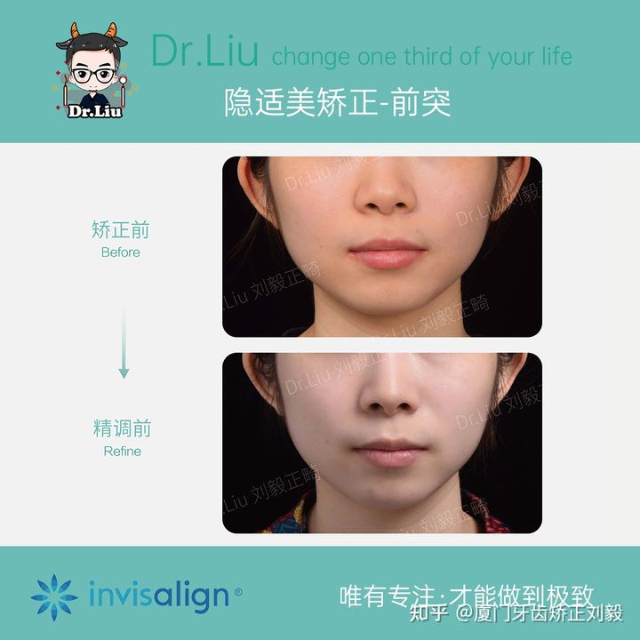 正畸临床拔牙矫治,拔牙正畸矫正嘴凸案例