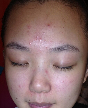 迅速解决青春痘的方法,青春痘怎么办最有效的方法