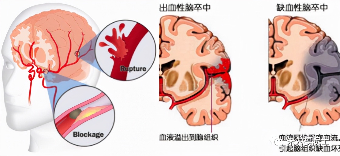 中风健康小知识,中风西医怎么预防