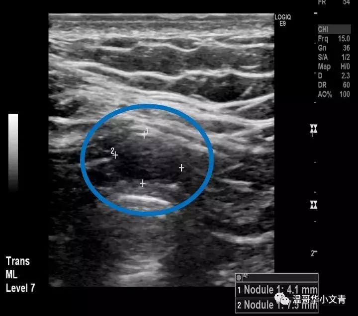 甲状腺癌治疗最好的医院排名,中药治疗甲状腺癌的有效方法